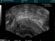 Obraz dělohy při vyšetření transvaginální sondou